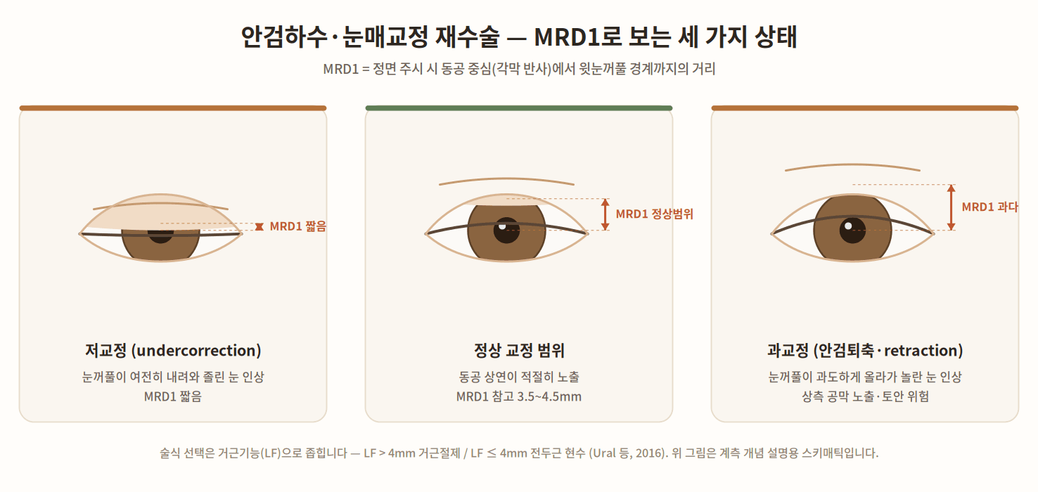 안검하수·눈매교정 재수술 MRD1 계측 도해 — 저교정(눈꺼풀이 내려와 졸린 눈, MRD1 짧음), 정상 교정 범위(동공 상연 노출, MRD1 참고 3.5~4.5mm), 과교정·안검퇴축(눈꺼풀이 과도하게 올라가 상측 공막 노출) 세 상태를 동공 중심에서 윗눈꺼풀 경계까지의 거리로 비교