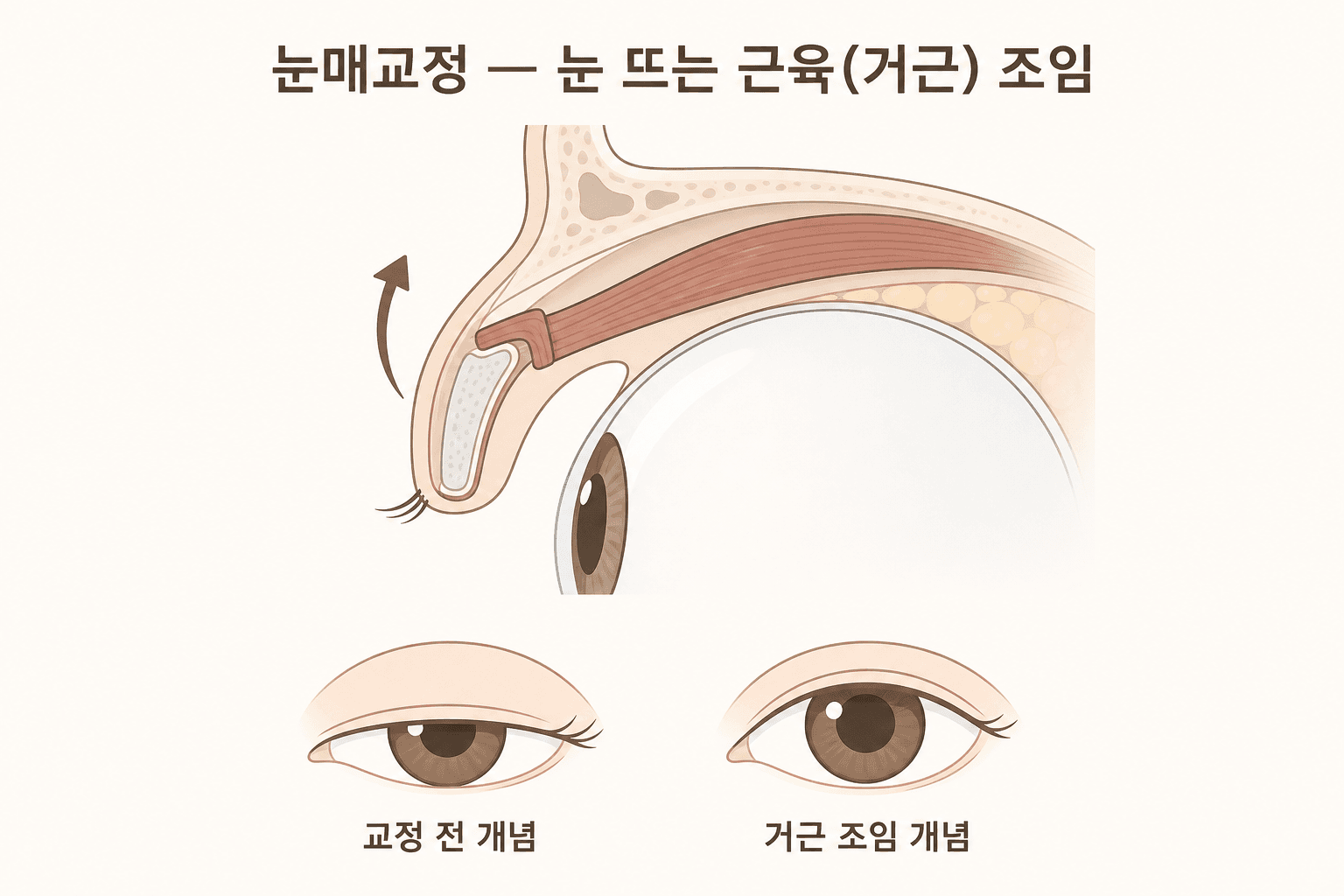눈매교정 원리 도해 — 윗눈꺼풀 단면에서 눈 뜨는 근육(거근)을 조여 눈꺼풀 높이를 올리는 개념, 교정 전 졸려 보이는 눈과 거근 조임 후 또렷한 눈 비교 일러스트