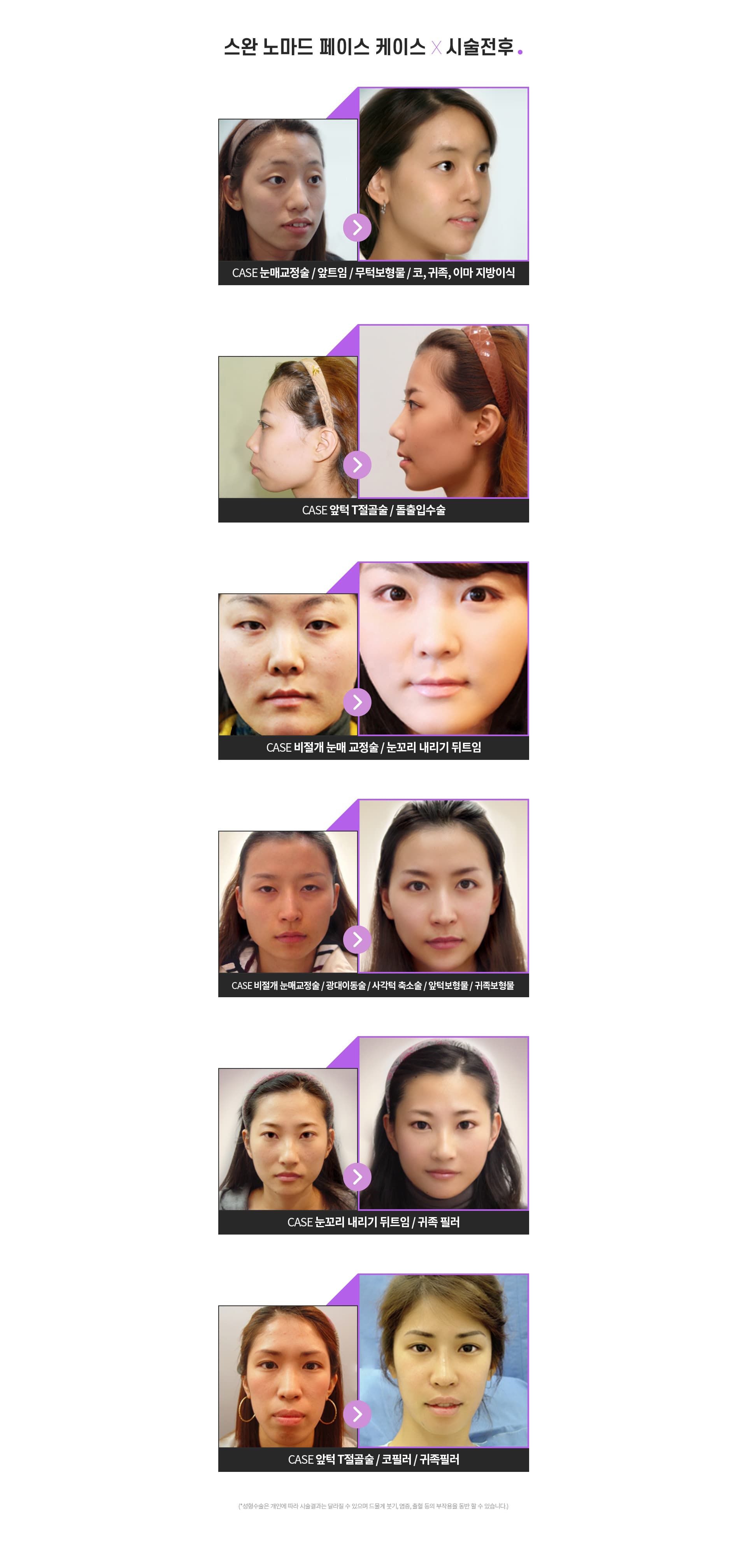 스완 노마드 페이스 케이스 시술전후