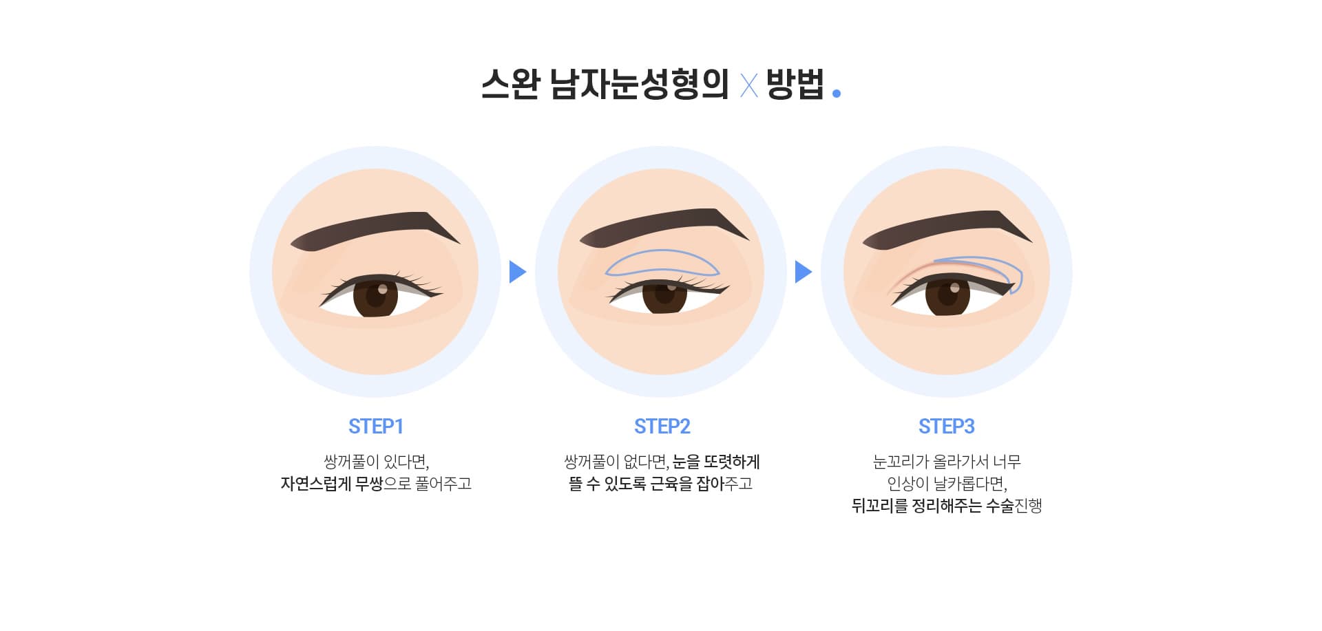 스완 남자눈성형의 방법