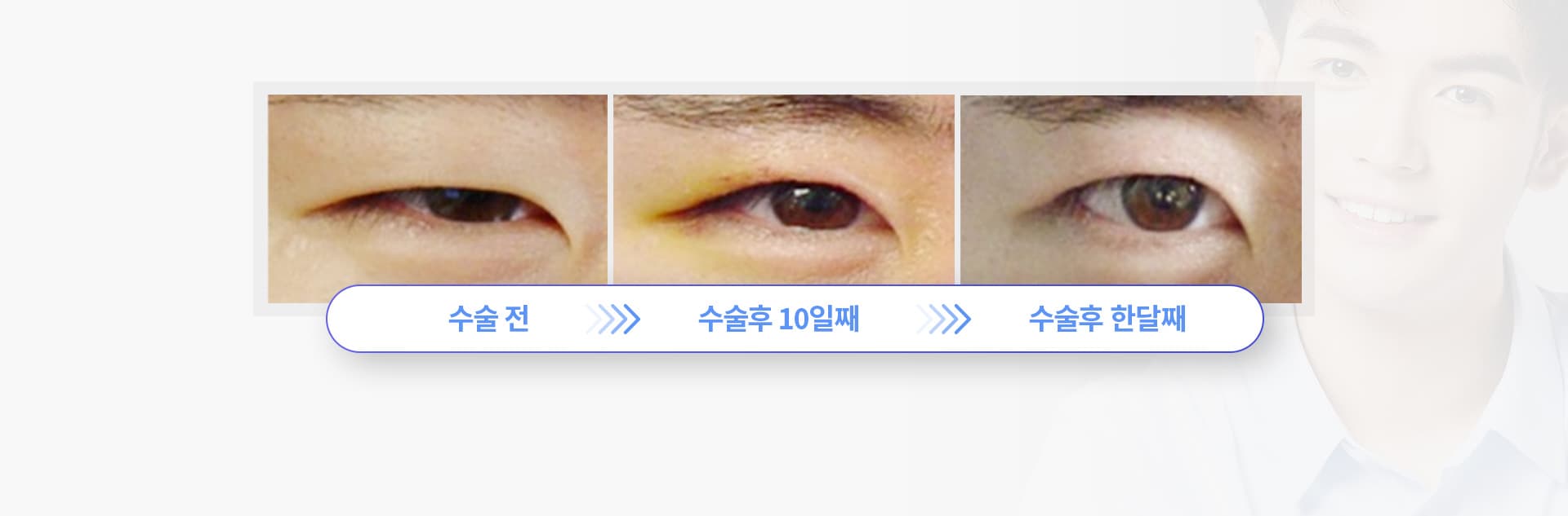 스완 남자눈성형의 경과