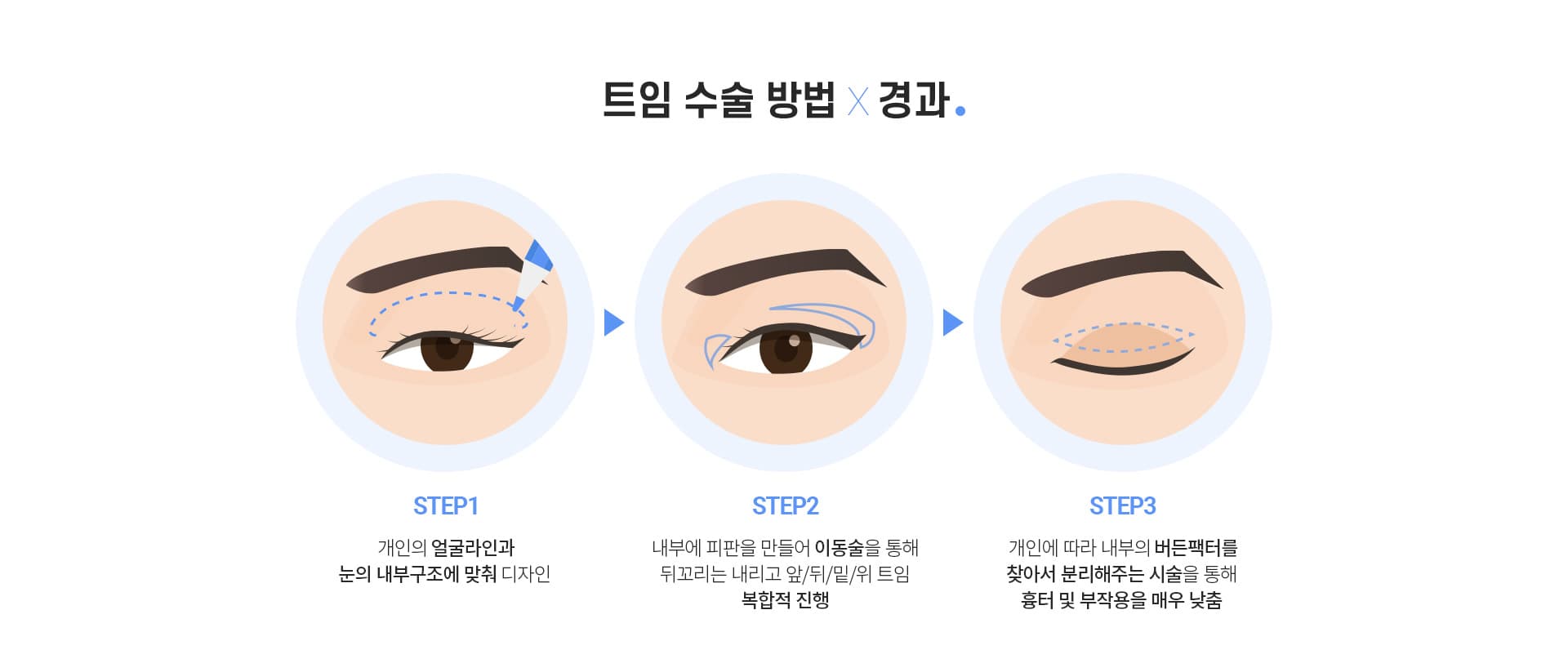 트임수술 방법