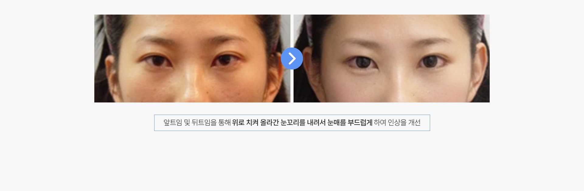트임수술 경과
