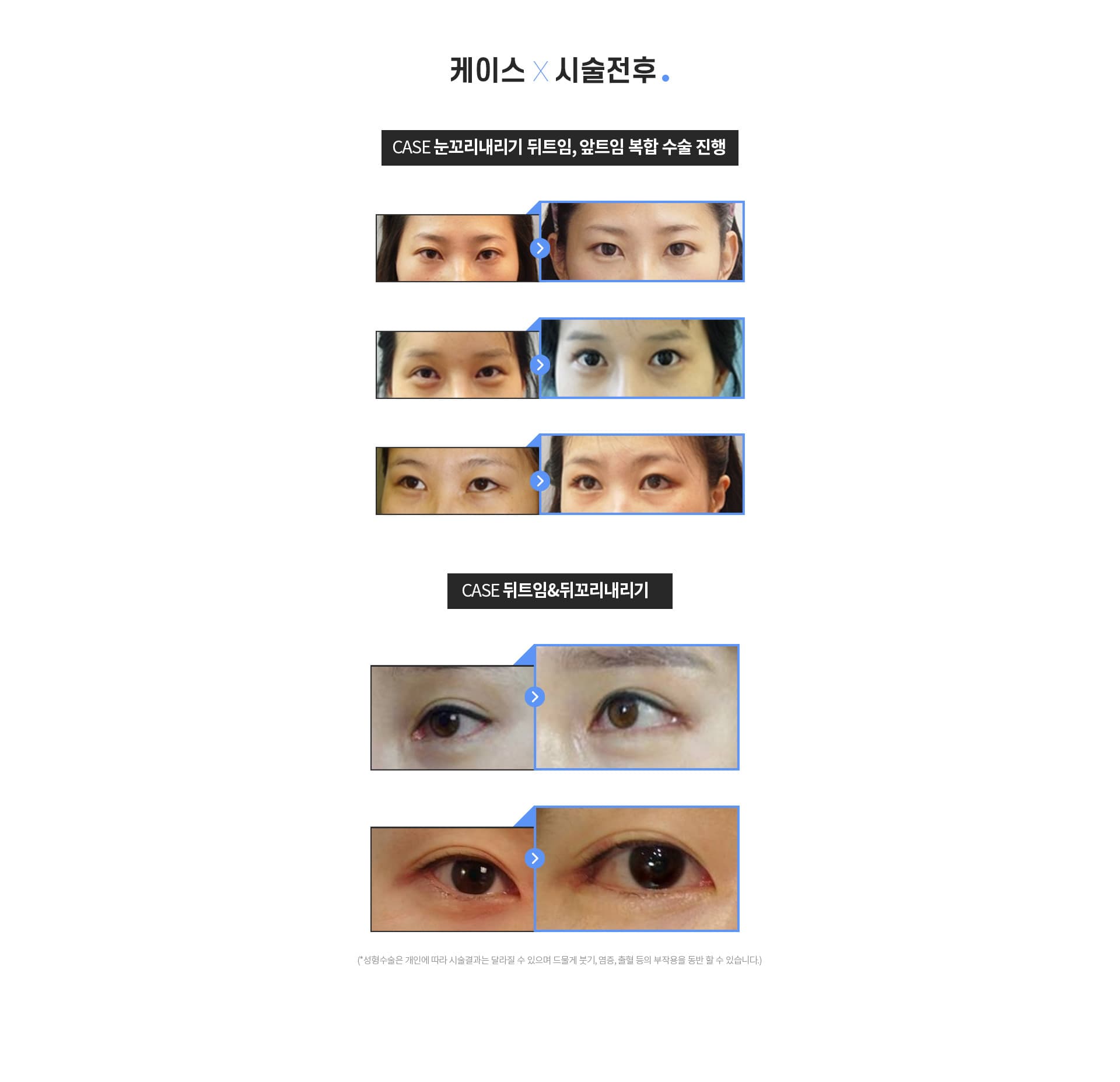 트임수술 시술전후