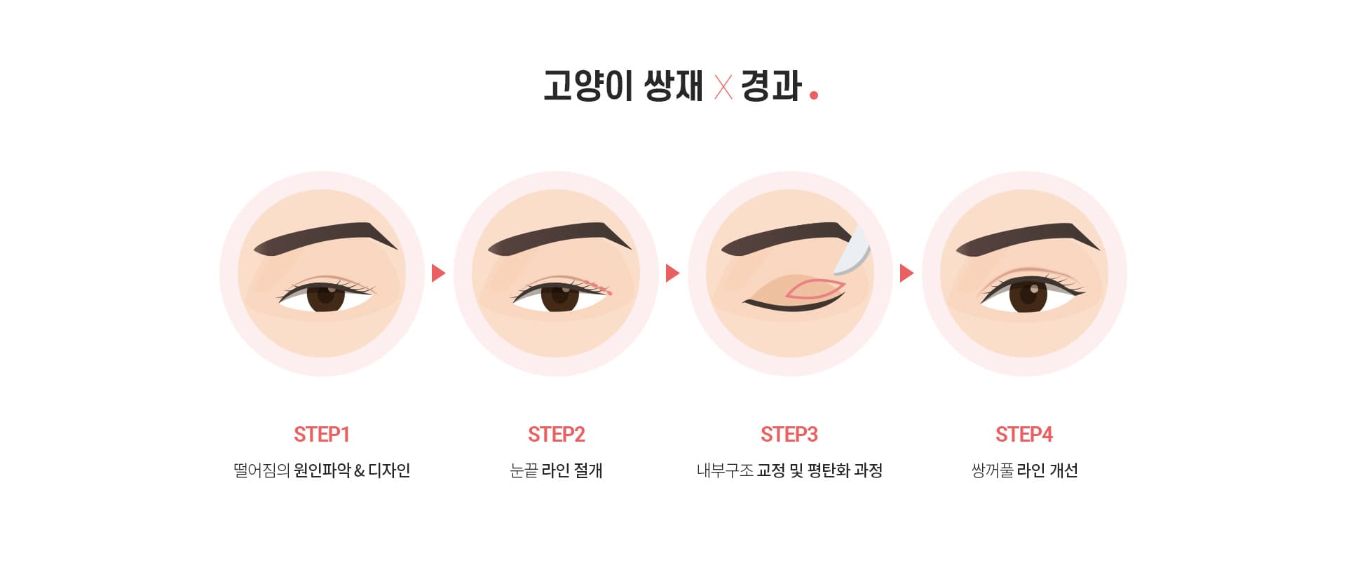 스완 고양이 눈성형 과정