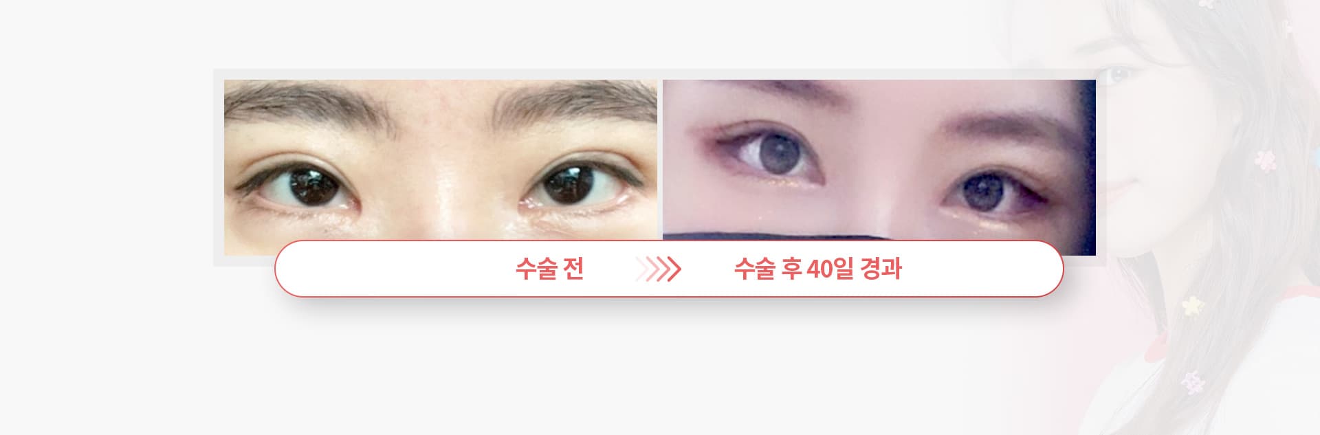 스완 고양이 눈성형 경과
