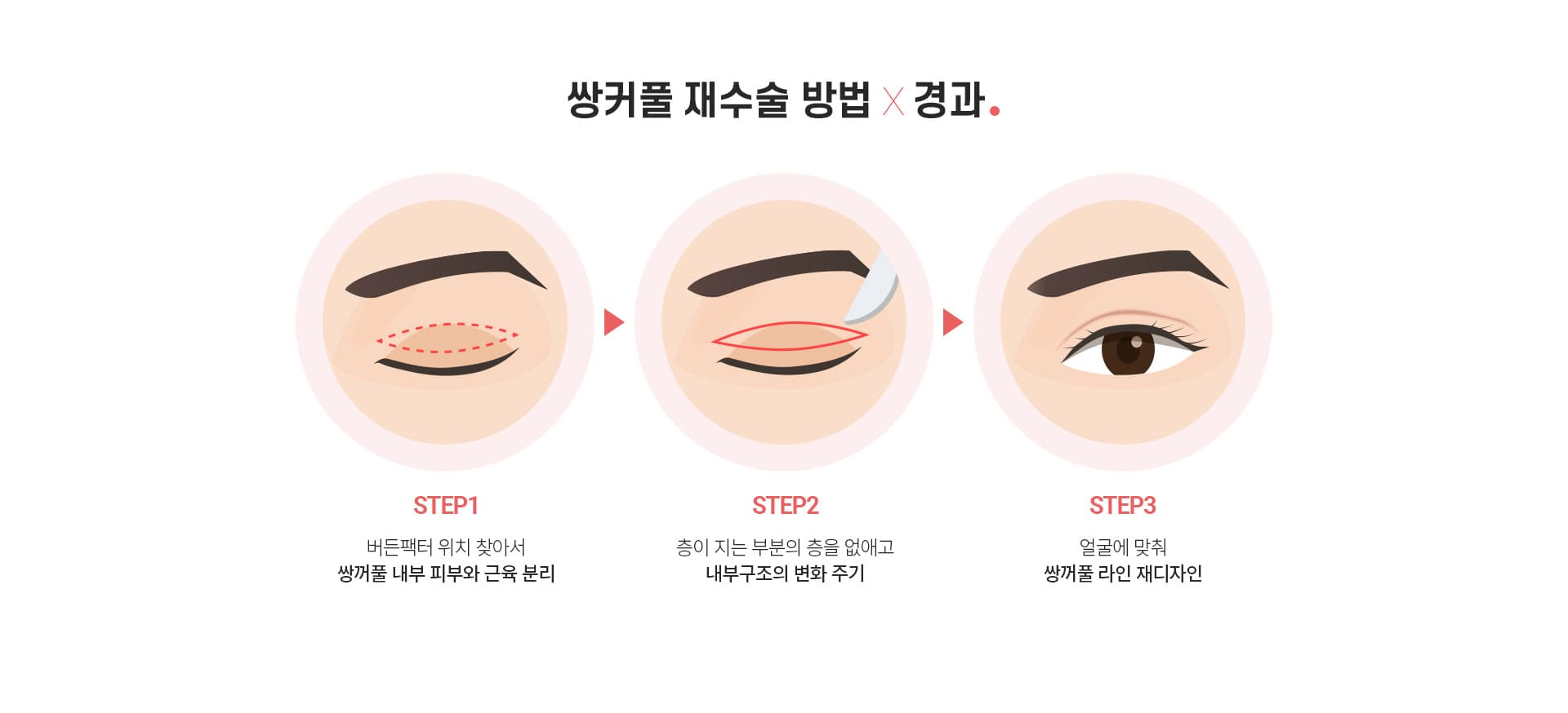쌍커풀 재수술 방법