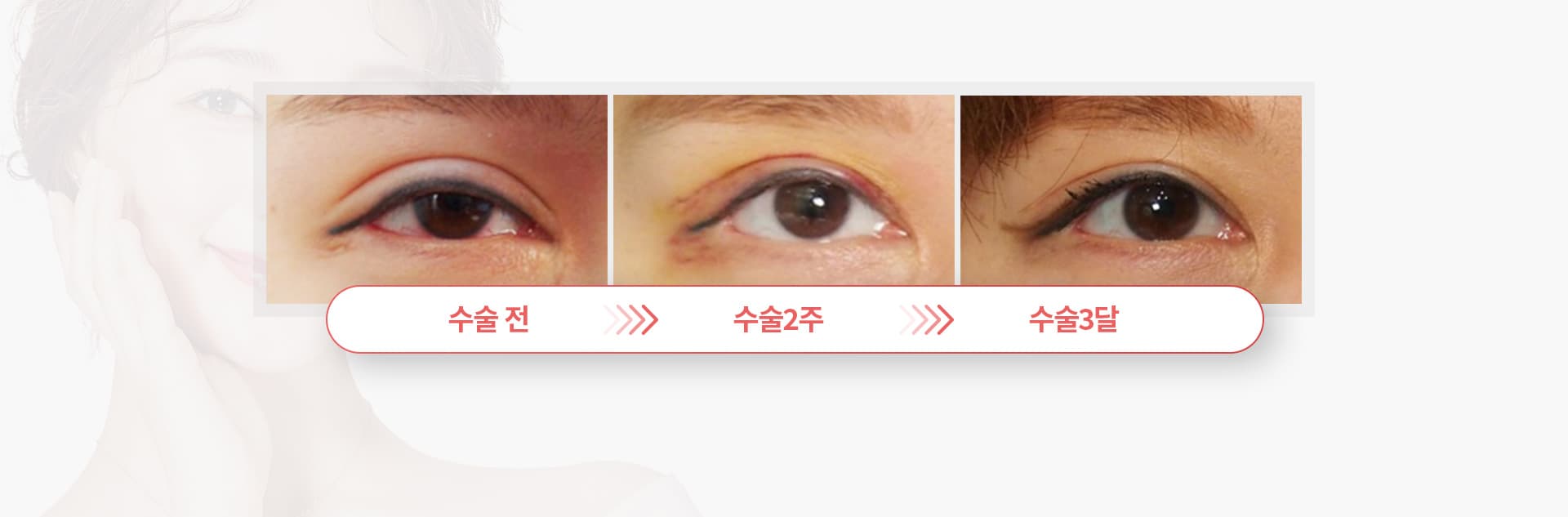 쌍커풀 재수술 경과