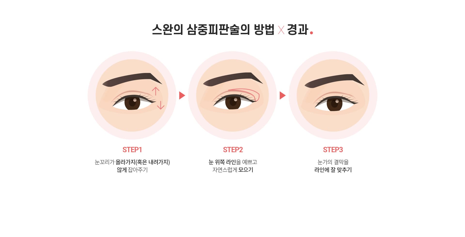 스완 삼중피판술의 방법