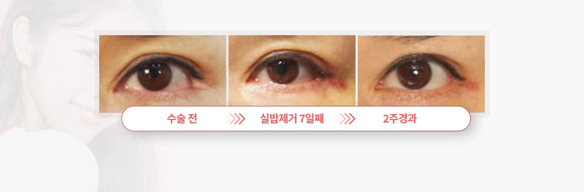 스완 삼중피판술의 경과