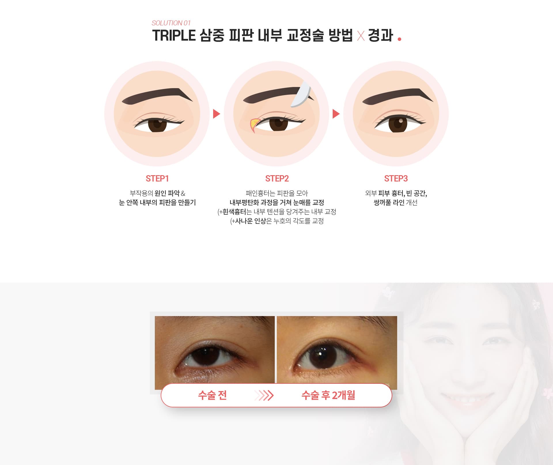 스완의 앞트임 흉터제거술의 방법