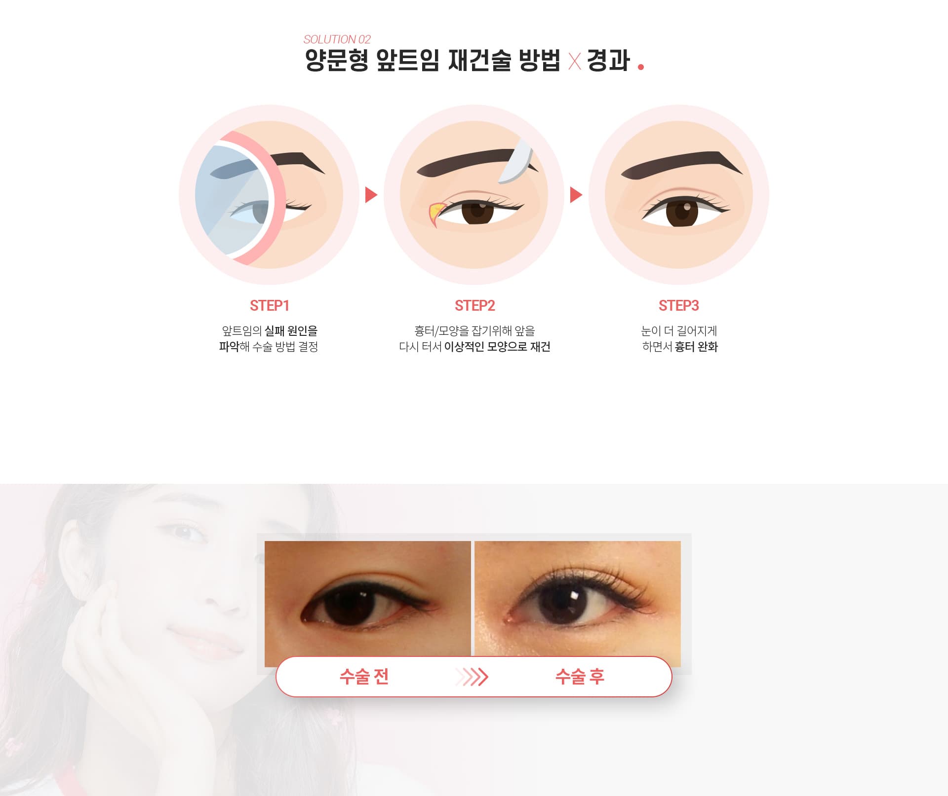 스완의 앞트임 흉터제거술의 경과