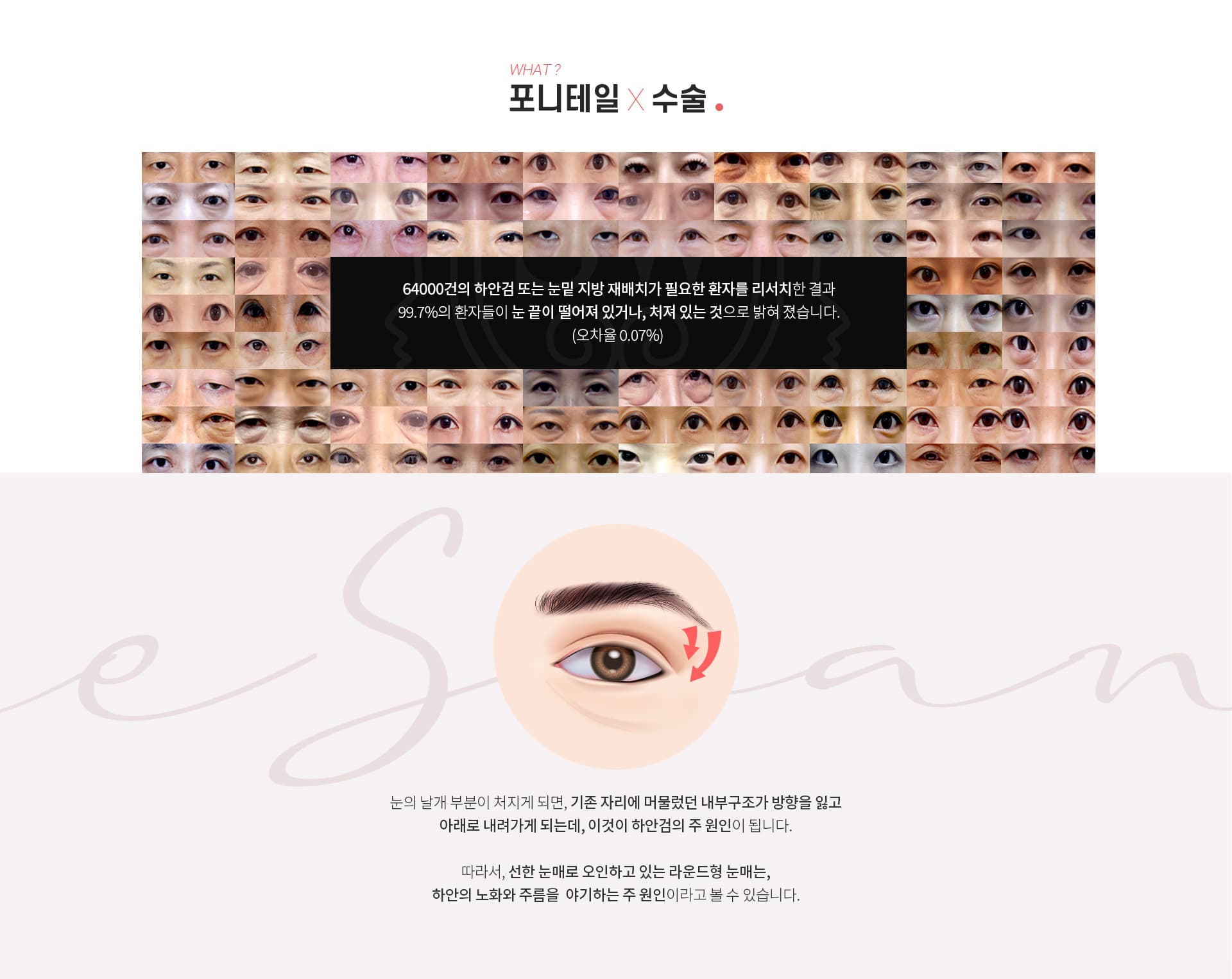 포니테일 수술 정의