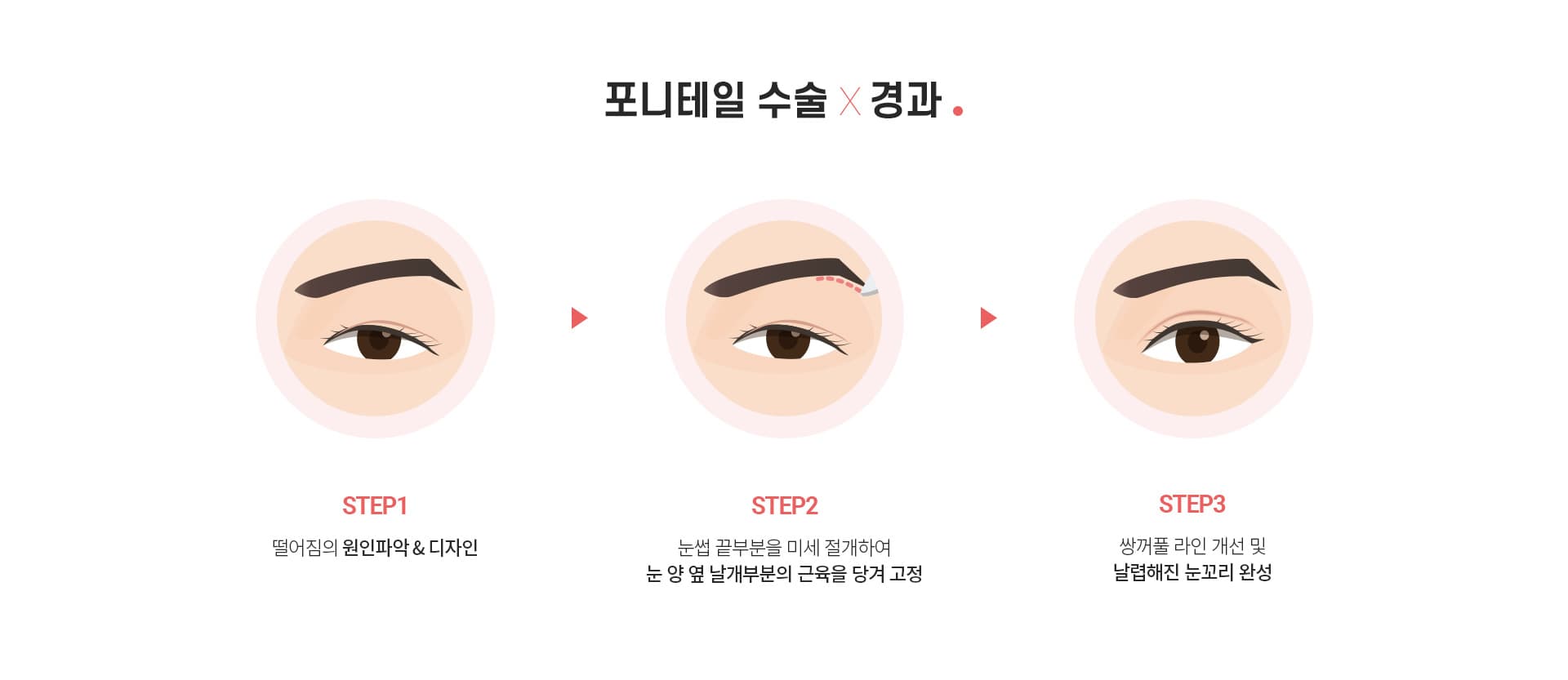 포니테일 수술 경과