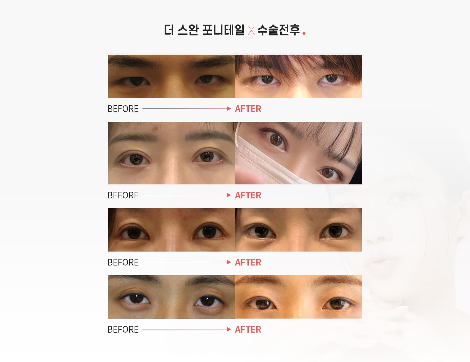 포니테일 수술 수술전후
