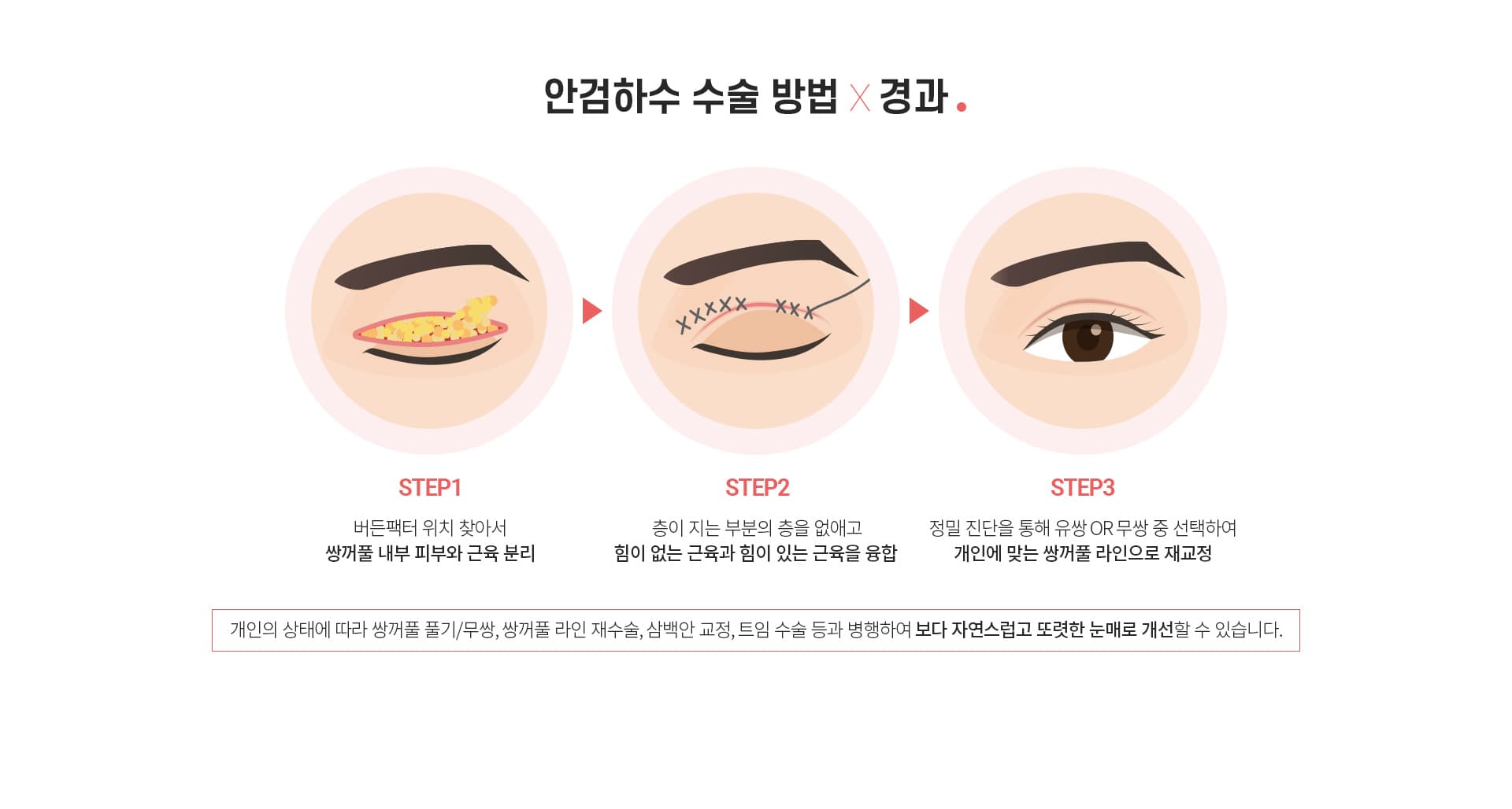 안검하수 수술 방법