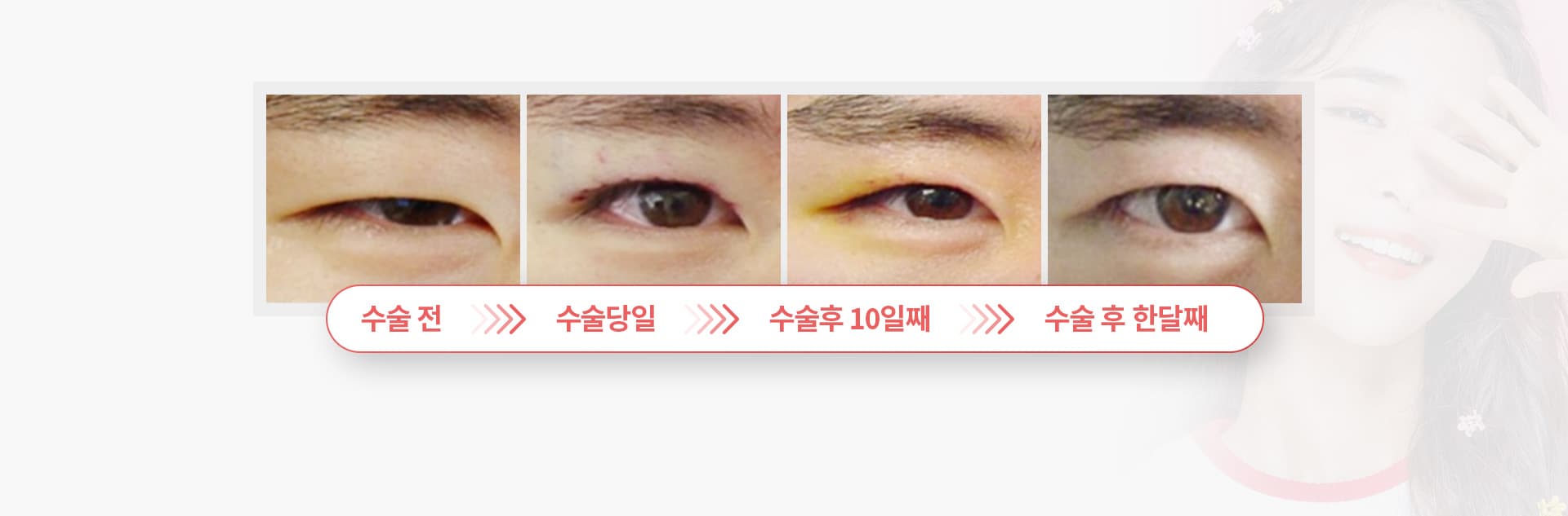 안검하수 수술 경과