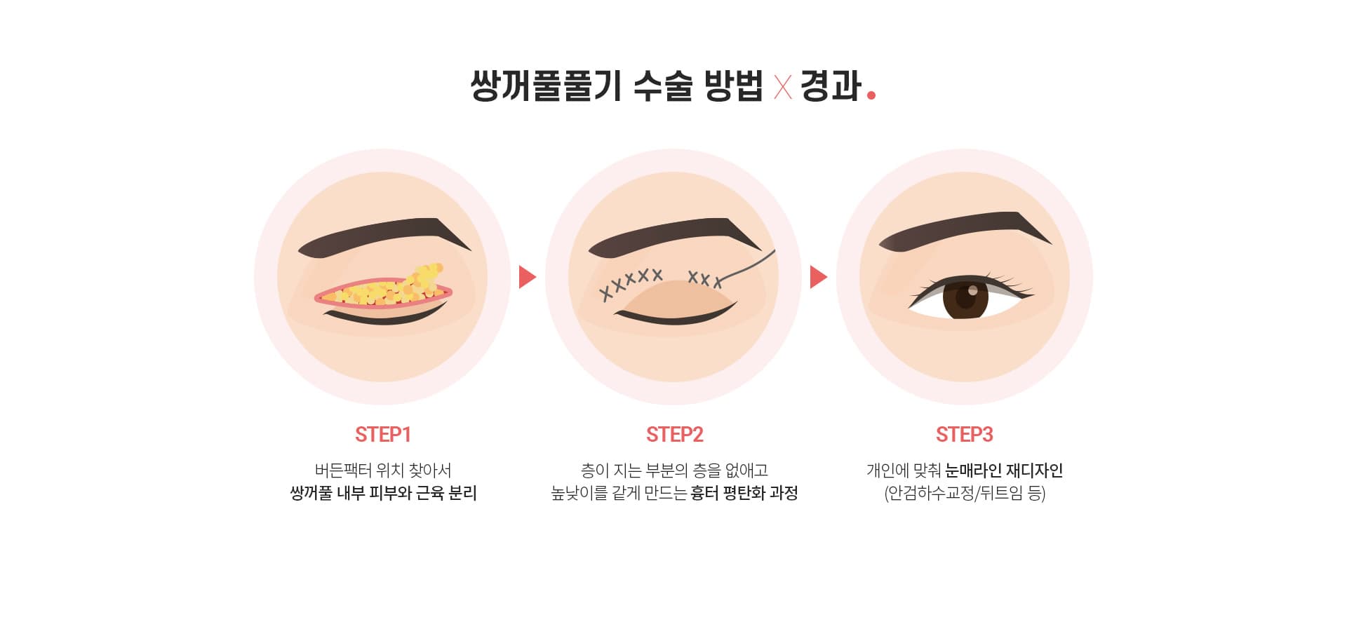 쌍꺼풀 풀기 수술 방법