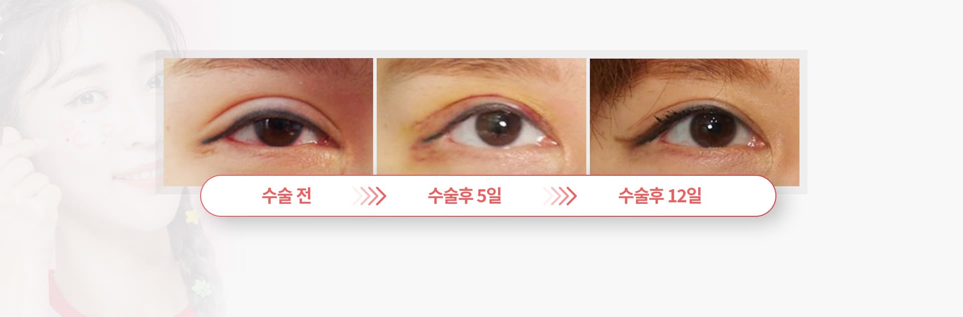 쌍꺼풀 풀기 수술 경과