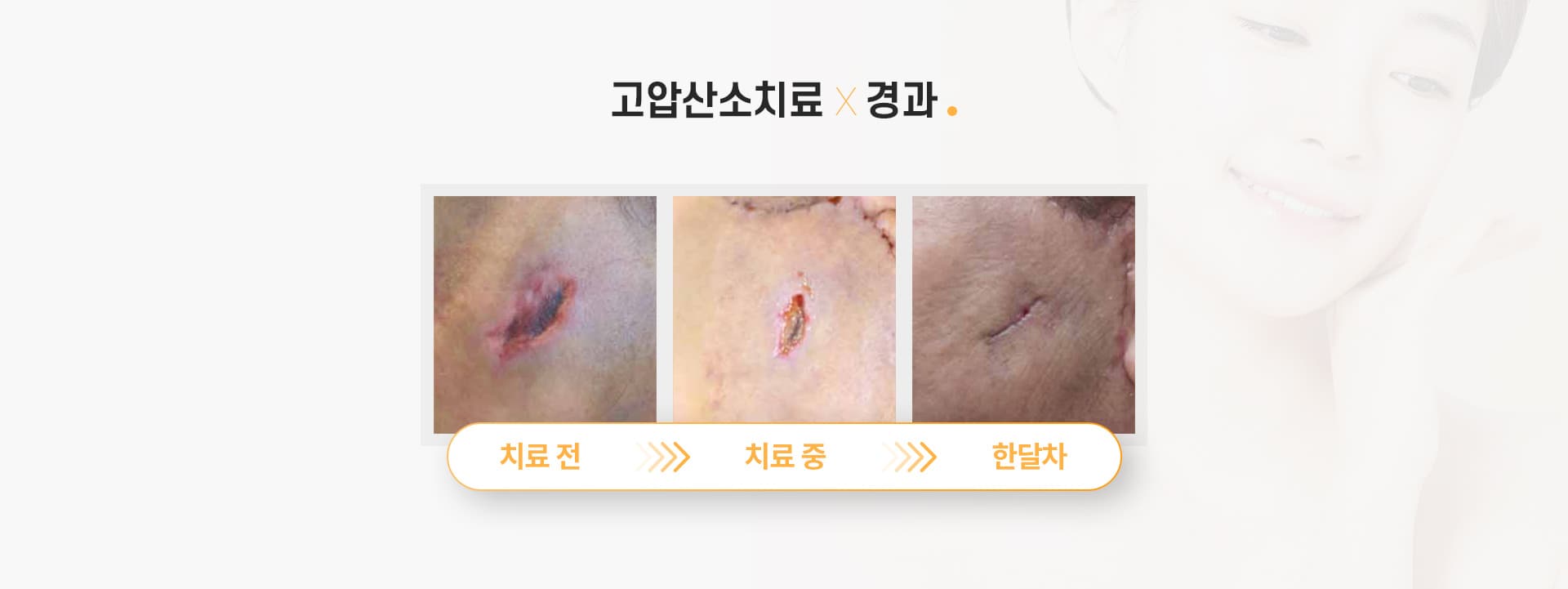 고압산소치료 진행 과정