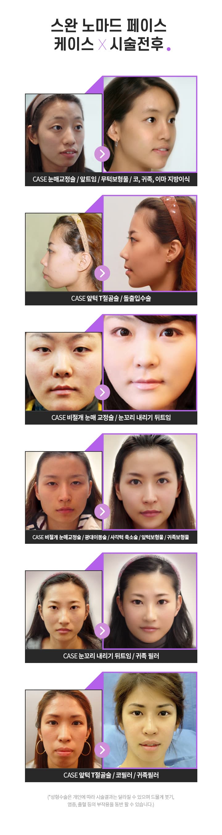 스완 노마드 페이스 케이스 시술전후