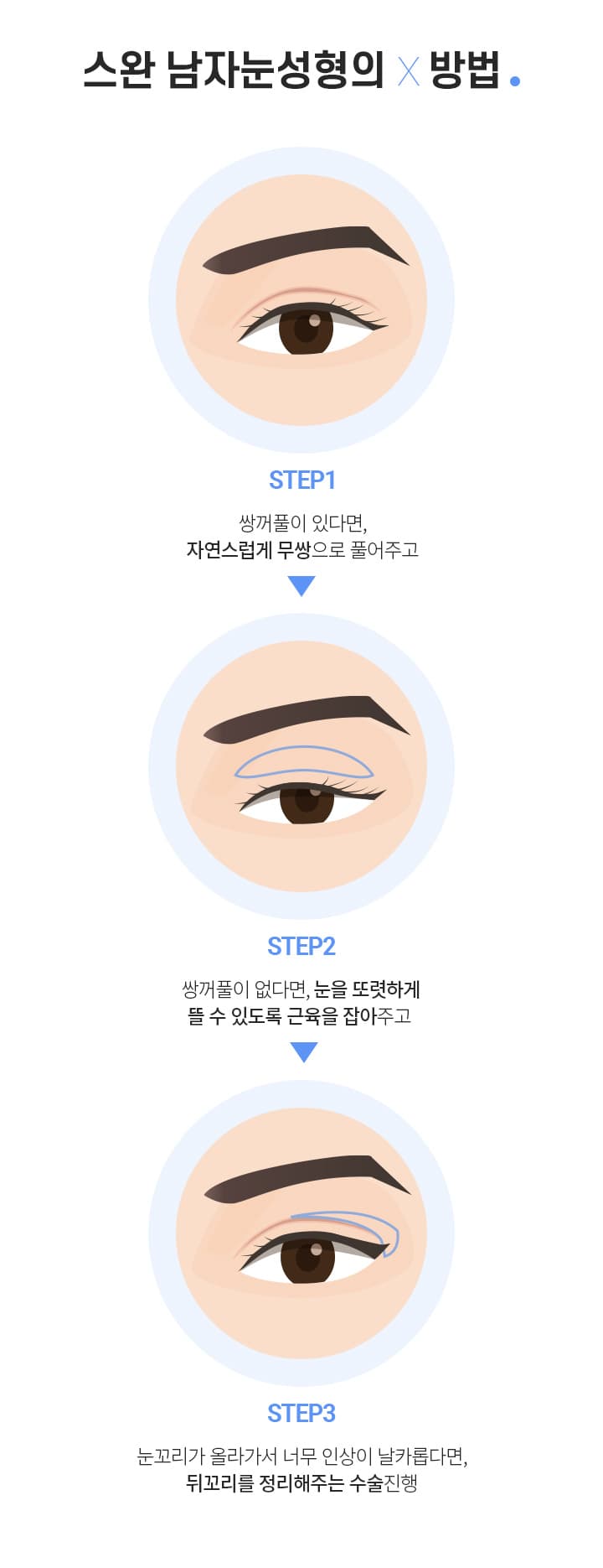 스완 남자눈성형의 방법
