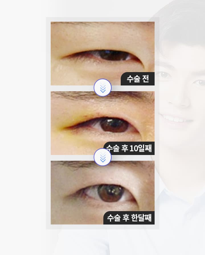 스완 남자눈성형의 경과