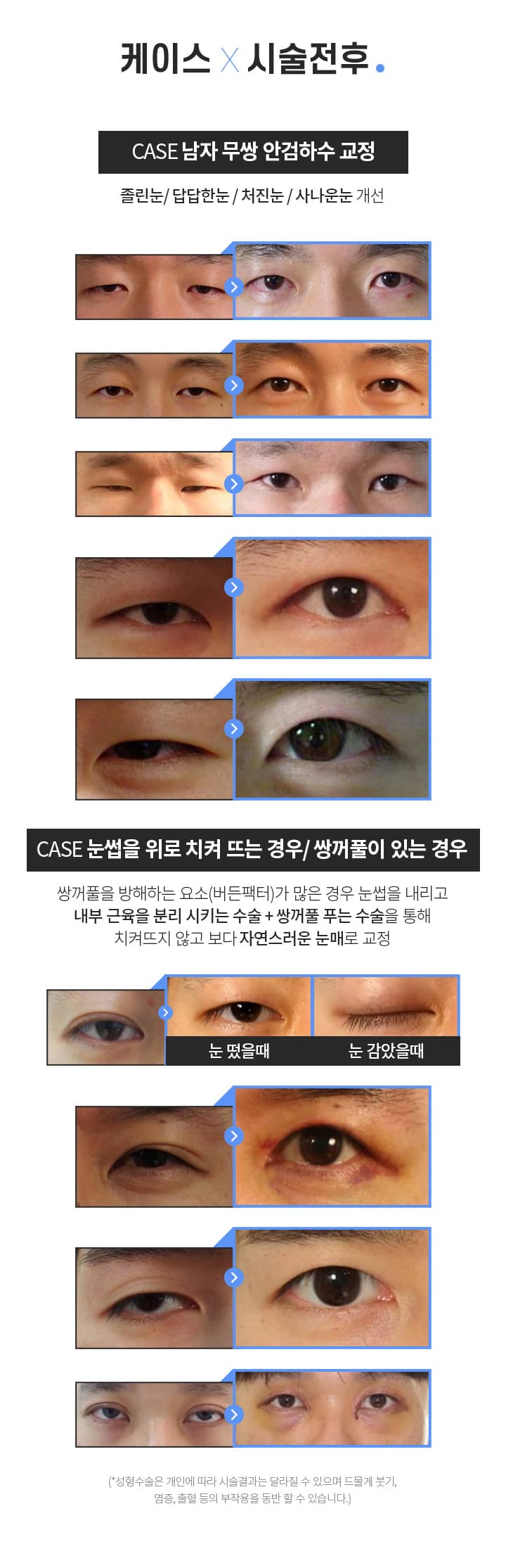 스완 남자눈성형 시술전후
