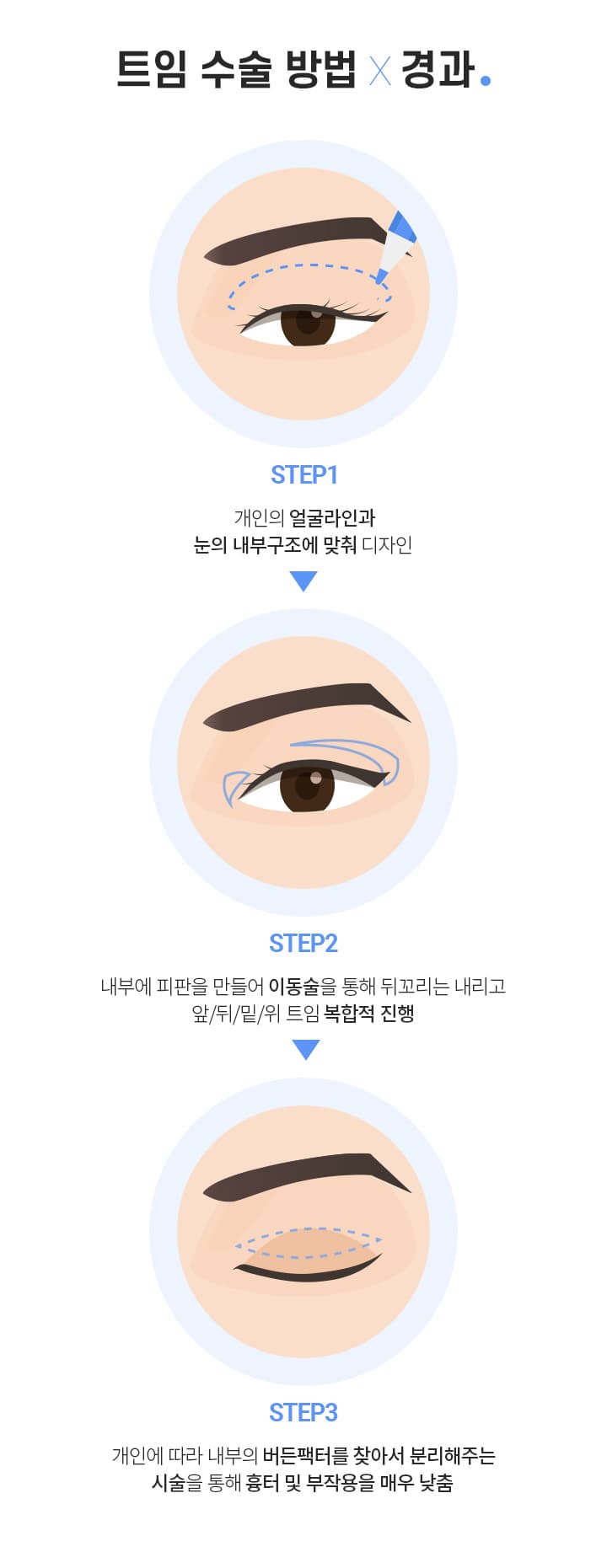 트임수술 방법