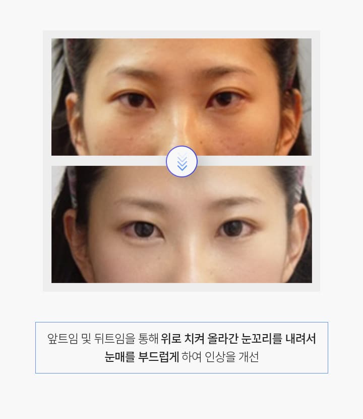 트임수술 경과