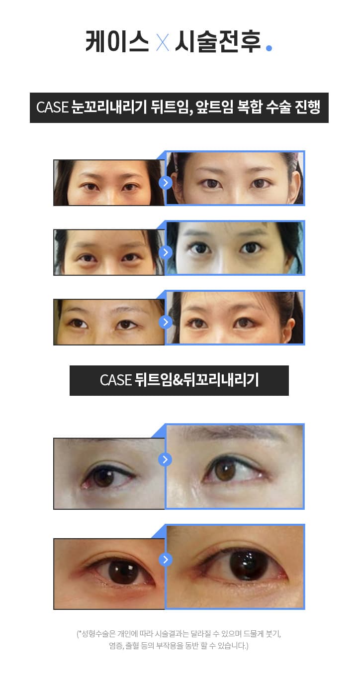 트임수술 시술전후
