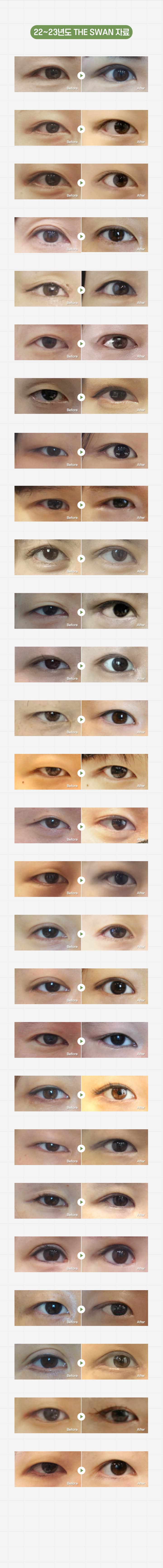 스완 매몰안검하수 시술전후