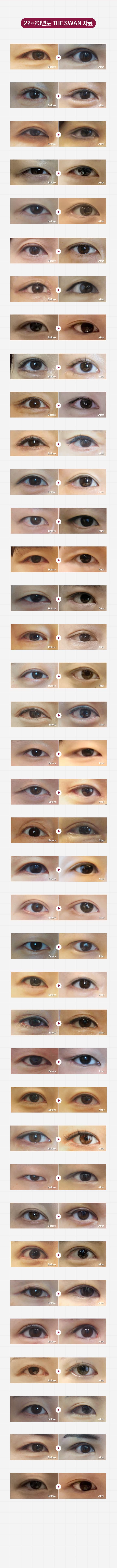 스완 포니테일 시술전후