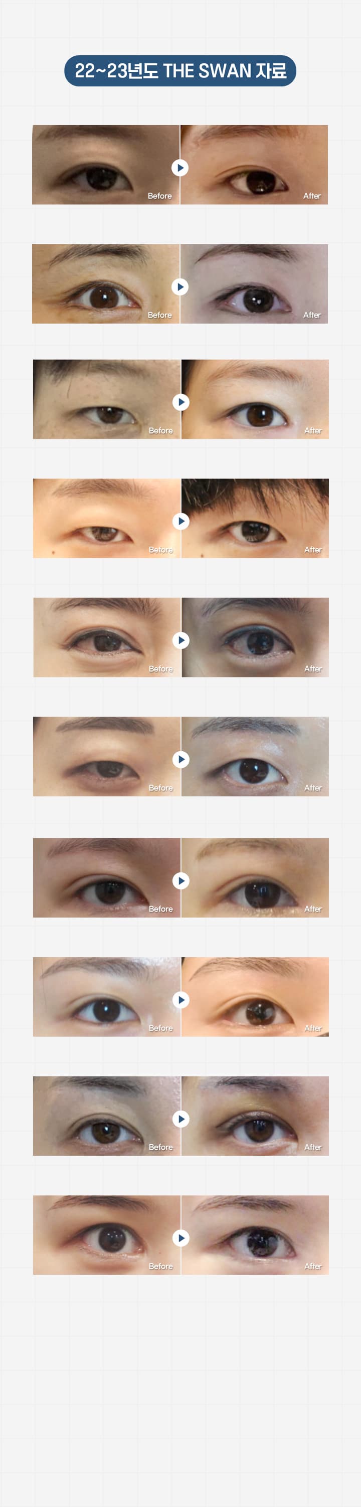 스완 눈썹하눈매교정 시술전후