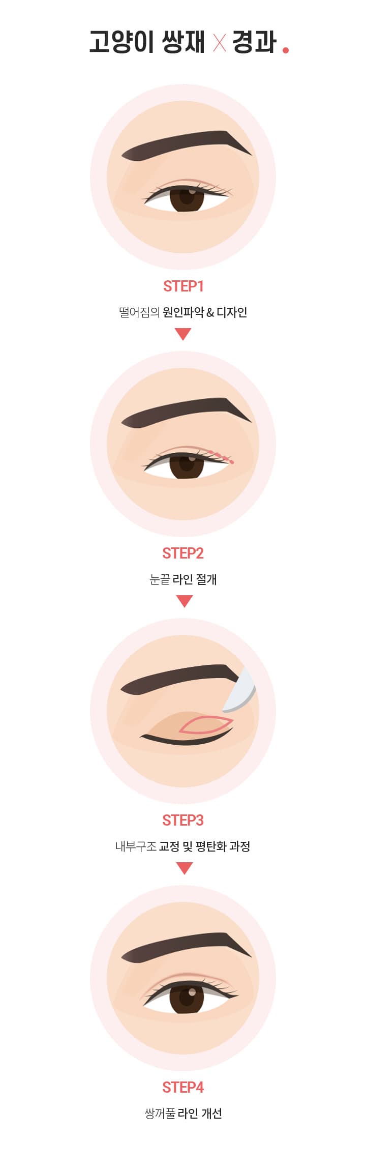 스완 고양이 눈성형 과정