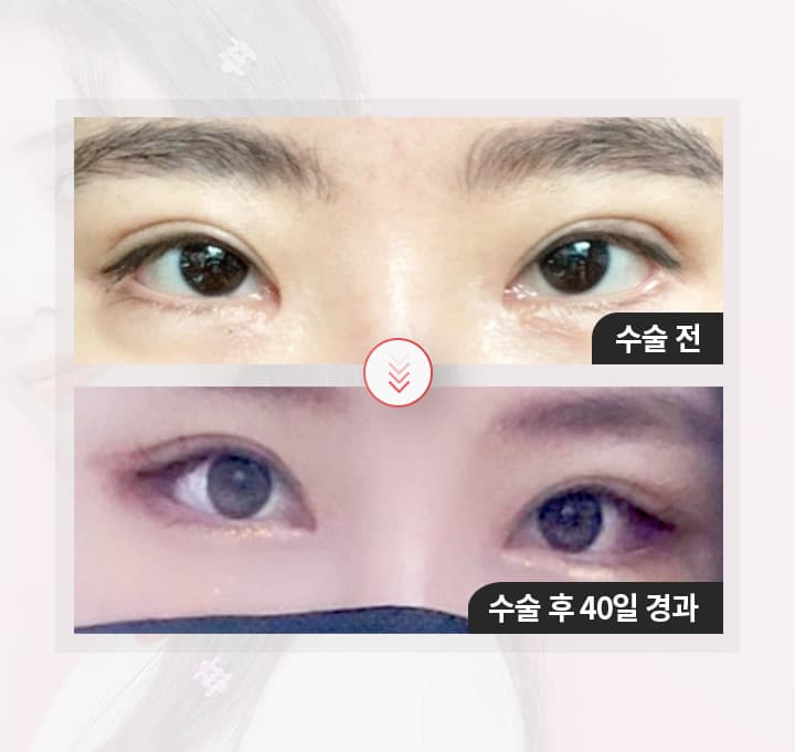 스완 고양이 눈성형 경과