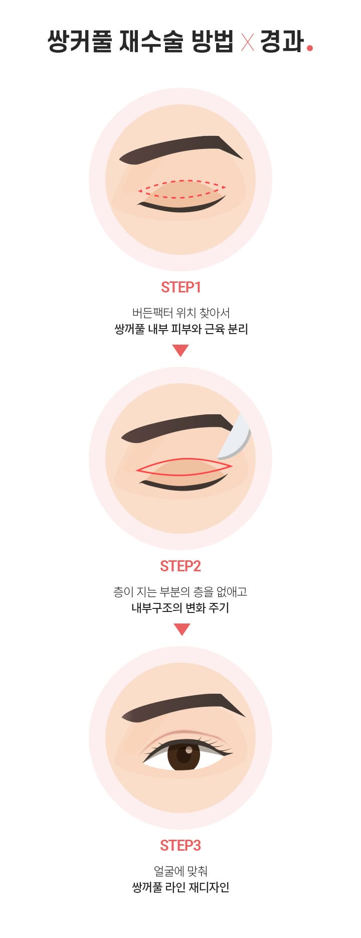 쌍커풀 재수술 방법