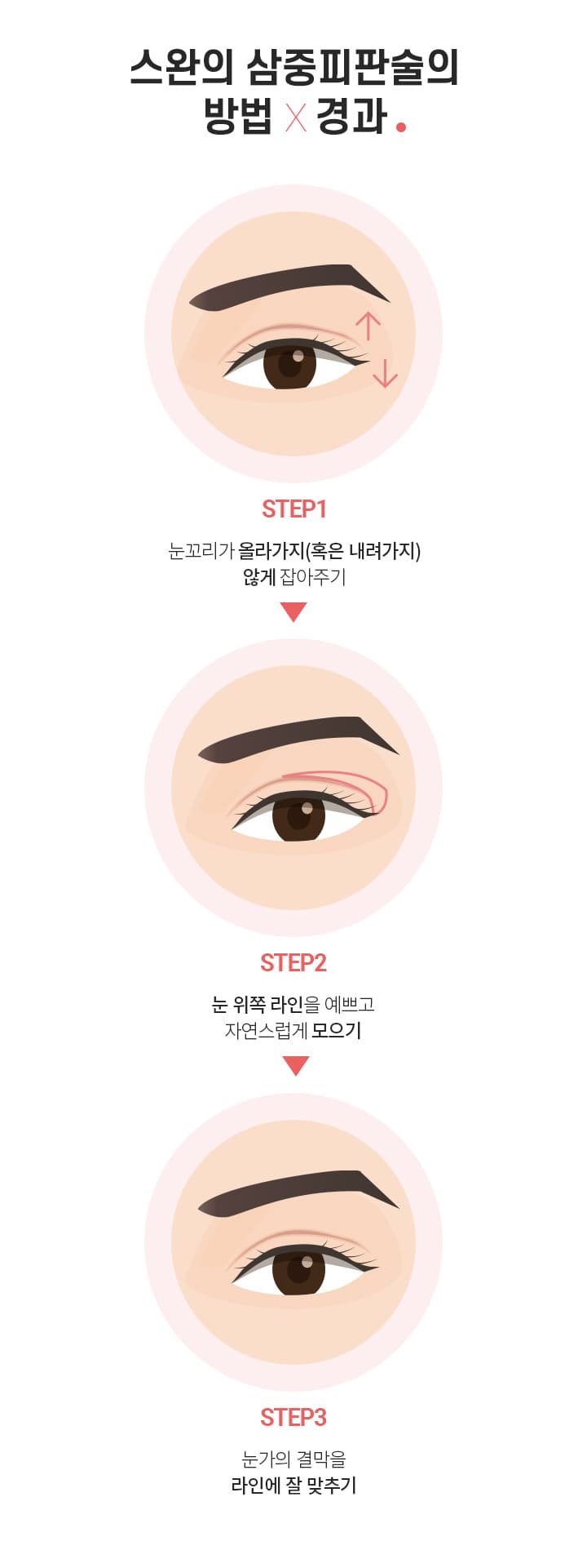 스완 삼중피판술의 방법
