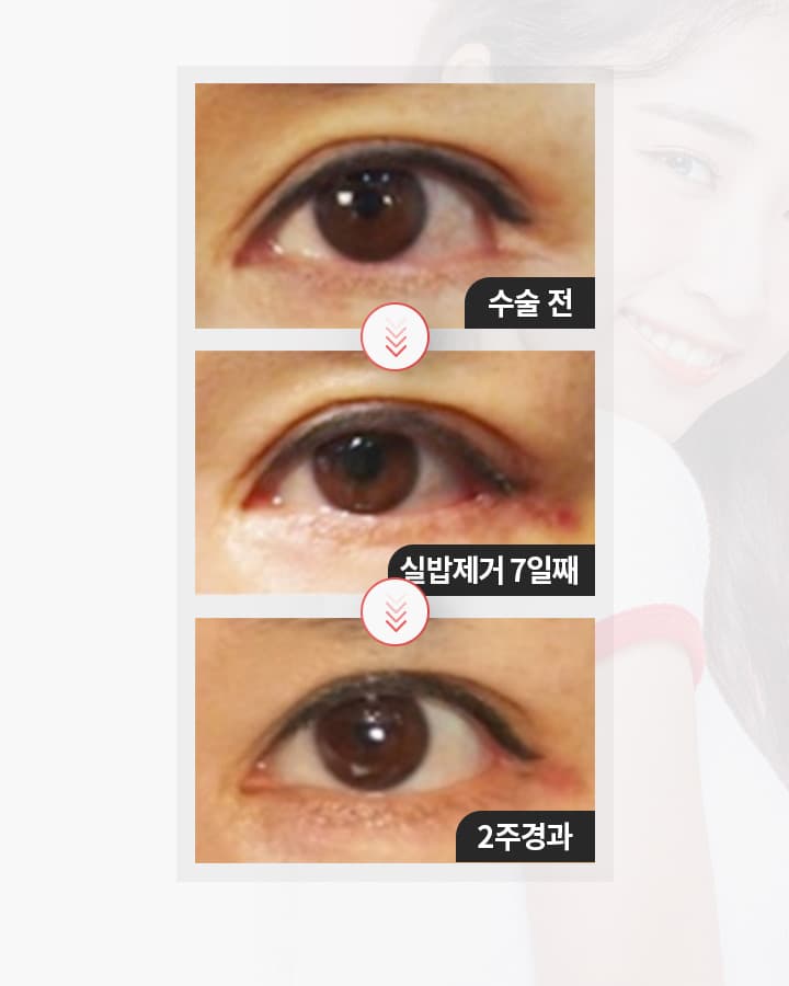 스완 삼중피판술의 경과