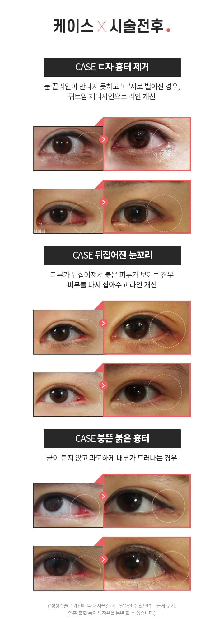 뒤트임 흉터제거 시술전후