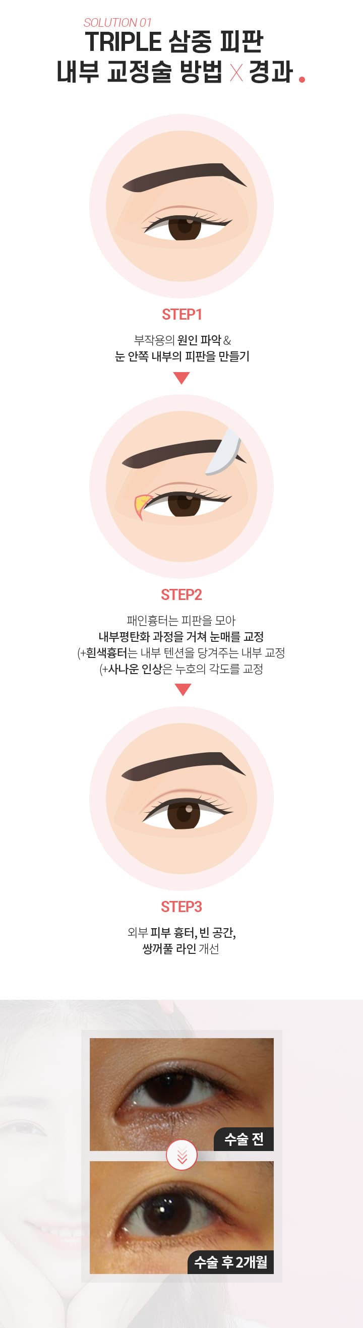 스완의 앞트임 흉터제거술의 방법