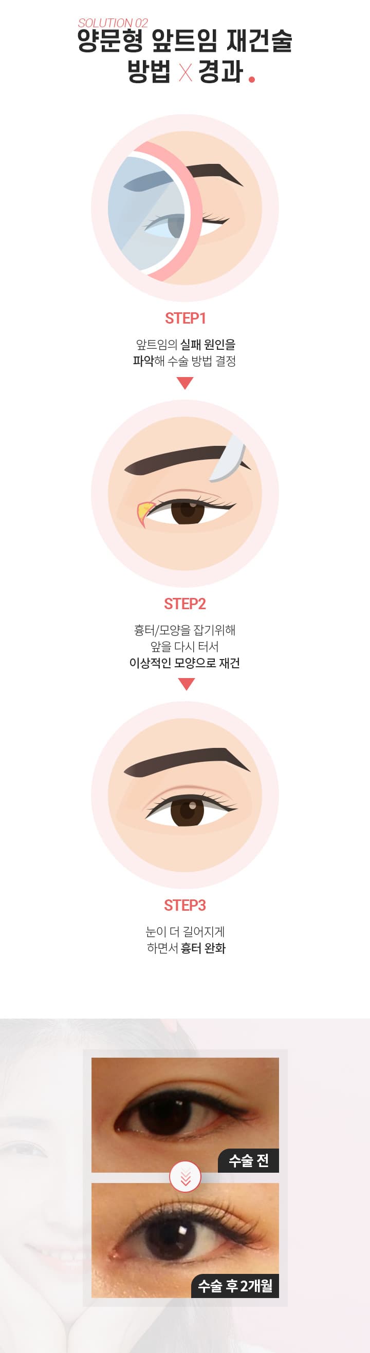 스완의 앞트임 흉터제거술의 경과