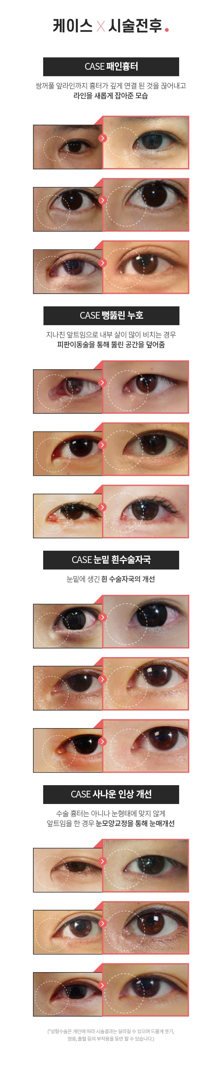 스완 케이스시술전후