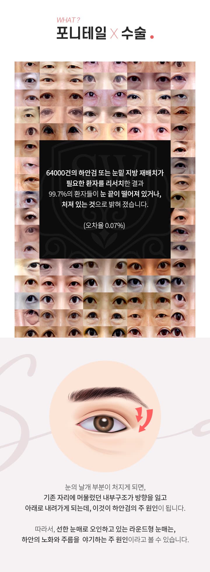 포니테일 수술 정의