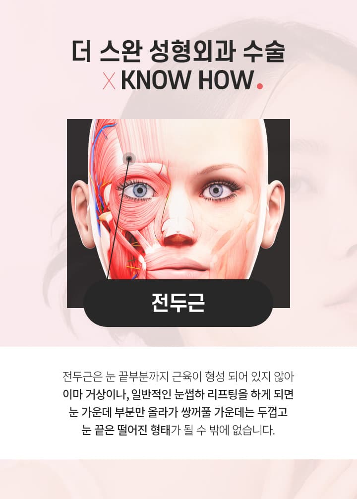 포니테일 수술 노하우