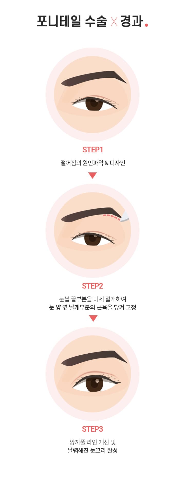 포니테일 수술 경과