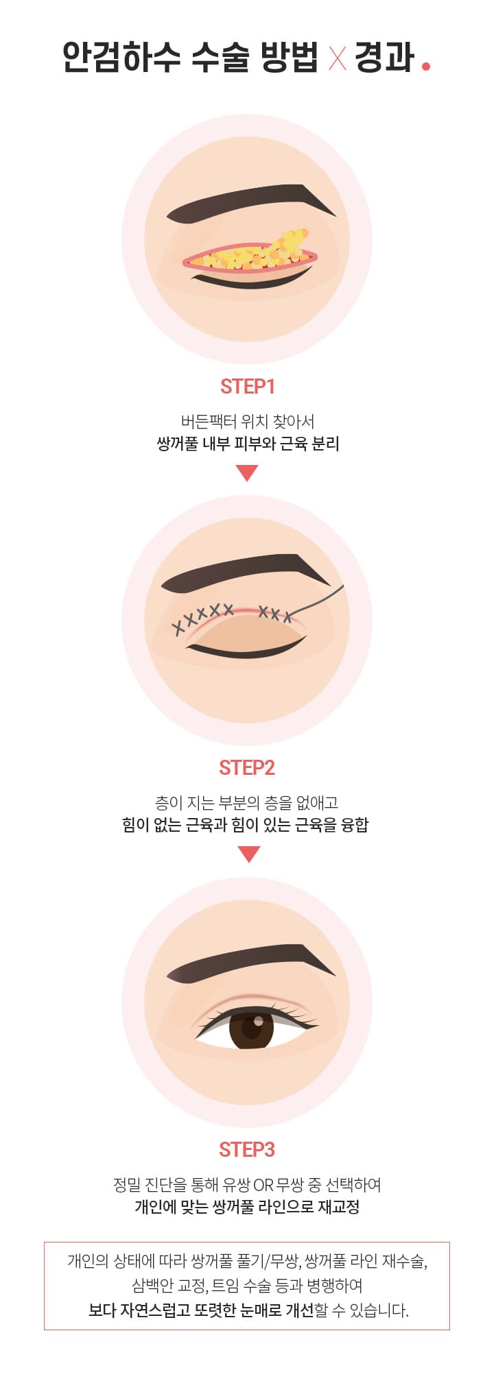 안검하수 수술 방법