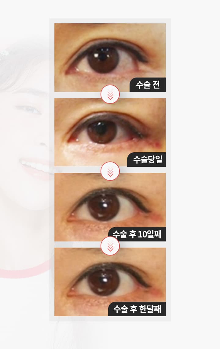 안검하수 수술 경과