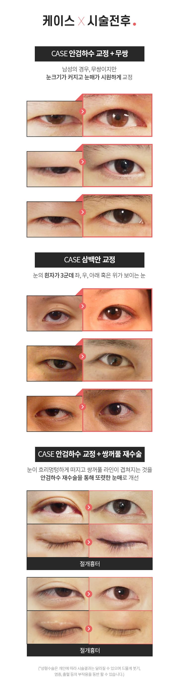 안검하수 재수술 시술전후