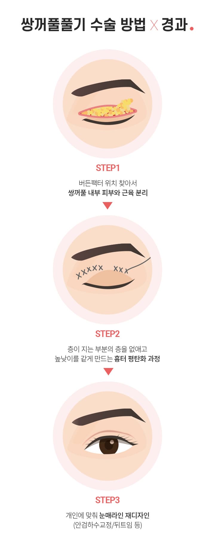 쌍꺼풀 풀기 수술 방법